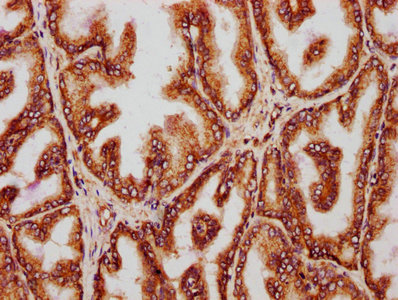 YWHAQ / 14-3-3 Theta Antibody - IHC image of YWHAQ Antibody diluted at 1:221 and staining in paraffin-embedded human prostate tissue performed on a Leica BondTM system. After dewaxing and hydration, antigen retrieval was mediated by high pressure in a citrate buffer (pH 6.0). Section was blocked with 10% normal goat serum 30min at RT. Then primary antibody (1% BSA) was incubated at 4°C overnight. The primary is detected by a biotinylated secondary antibody and visualized using an HRP conjugated SP system.