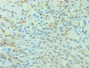 YWHAQ / 14-3-3 Theta Antibody - Immunohistochemistry of paraffin-embedded human breast cancer using antibody at 1:100 dilution.