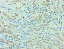 YWHAQ / 14-3-3 Theta Antibody - Immunohistochemistry of paraffin-embedded human breast cancer using antibody at 1:100 dilution.