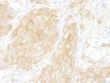 YWHAQ / 14-3-3 Theta Antibody - Detection of Human 14-3-3-theta by Immunohistochemistry. Sample: FFPE section of human breast carcinoma. Antibody: Affinity purified rabbit anti-14-3-3-theta used at a dilution of 1:1000 (1 ug/ml). Detection: DAB.