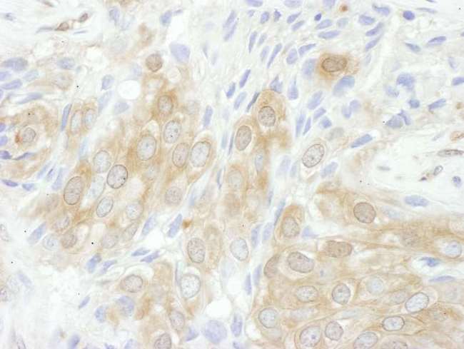YWHAQ / 14-3-3 Theta Antibody - Detection of Human 14-3-3-theta by Immunohistochemistry. Sample: FFPE section of human breast carcinoma. Antibody: Affinity purified rabbit anti-14-3-3-theta used at a dilution of 1:5000 (0.2 ug/ml). Detection: DAB.