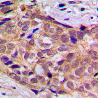 YWHAQ / 14-3-3 Theta Antibody - Immunohistochemical analysis of 14-3-3 theta staining in human prostate cancer formalin fixed paraffin embedded tissue section. The section was pre-treated using heat mediated antigen retrieval with sodium citrate buffer (pH 6.0). The section was then incubated with the antibody at room temperature and detected using an HRP conjugated compact polymer system. DAB was used as the chromogen. The section was then counterstained with hematoxylin and mounted with DPX.