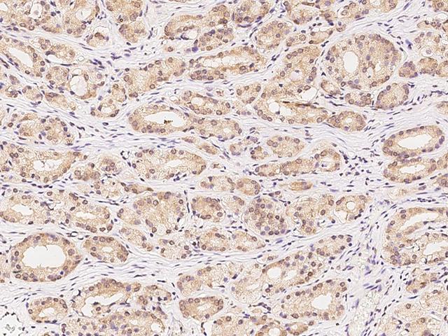 YWHAQ / 14-3-3 Theta Antibody - Immunochemical staining of human YWHAQ in human prostatic carcinoma with rabbit polyclonal antibody at 1:100 dilution, formalin-fixed paraffin embedded sections.