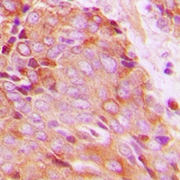 YWHAZ / 14-3-3 Zeta Antibody - Immunohistochemical analysis of 14-3-3 zeta (pT232) staining in human breast cancer formalin fixed paraffin embedded tissue section. The section was pre-treated using heat mediated antigen retrieval with sodium citrate buffer (pH 6.0). The section was then incubated with the antibody at room temperature and detected with HRP and DAB as chromogen. The section was then counterstained with hematoxylin and mounted with DPX.
