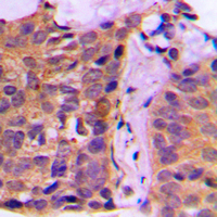 YWHAZ / 14-3-3 Zeta Antibody - Immunohistochemical analysis of 14-3-3 zeta staining in human breast cancer formalin fixed paraffin embedded tissue section. The section was pre-treated using heat mediated antigen retrieval with sodium citrate buffer (pH 6.0). The section was then incubated with the antibody at room temperature and detected using an HRP conjugated compact polymer system. DAB was used as the chromogen. The section was then counterstained with hematoxylin and mounted with DPX.