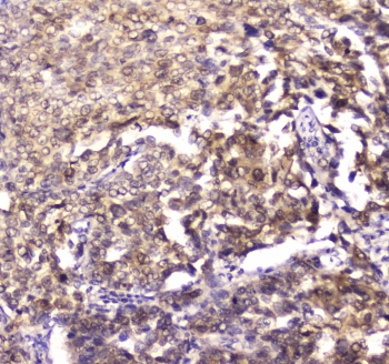 YWHAZ / 14-3-3 Zeta Antibody - IHC testing of FFPE human lung cancer tissue with 14-3-3 zeta antibody at 1ug/ml. Required HIER: steam section in pH6 citrate buffer for 20 min and allow to cool prior to staining.