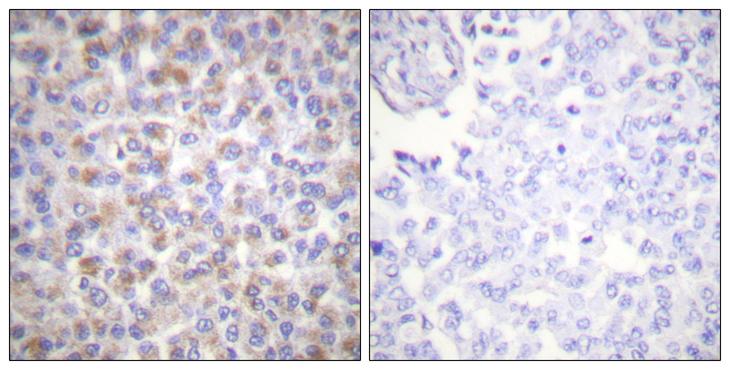 YWHAZ / 14-3-3 Zeta Antibody - Peptide - + Immunohistochemical analysis of paraffin-embedded human breast carcinoma tissue using 14-3-3 ? (Ab-58) antibody.