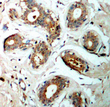 YWHAZ / 14-3-3 Zeta Antibody - Immunohistochemical analysis of paraffin-embedded human breast carcinoma tissue.