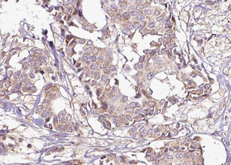 YWHAZ / 14-3-3 Zeta Antibody - 1:100 staining human breast carcinoma tissue by IHC-P. The tissue was formaldehyde fixed and a heat mediated antigen retrieval step in citrate buffer was performed. The tissue was then blocked and incubated with the antibody for 1.5 hours at 22°C. An HRP conjugated goat anti-rabbit antibody was used as the secondary.