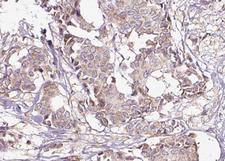 YWHAZ / 14-3-3 Zeta Antibody - 1:100 staining human breast carcinoma tissue by IHC-P. The tissue was formaldehyde fixed and a heat mediated antigen retrieval step in citrate buffer was performed. The tissue was then blocked and incubated with the antibody for 1.5 hours at 22°C. An HRP conjugated goat anti-rabbit antibody was used as the secondary.