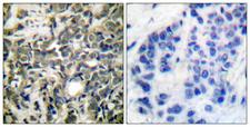 YWHAZ / 14-3-3 Zeta Antibody - P-peptide - + Immunohistochemical analysis of paraffin-embedded human breast carcinoma tissue using 14-3-3 ? (phospho-Ser58) antibody.