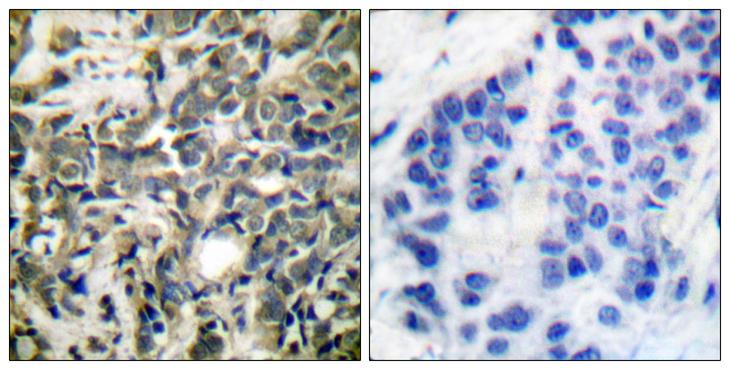 YWHAZ / 14-3-3 Zeta Antibody - P-peptide - + Immunohistochemical analysis of paraffin-embedded human breast carcinoma tissue using 14-3-3 ? (phospho-Ser58) antibody.