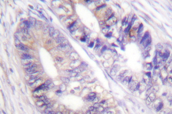 YWHAZ / 14-3-3 Zeta Antibody - IHC of 14-3-3 / (W228) pAb in paraffin-embedded human colon carcinoma tissue.