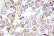 YWHAZ / 14-3-3 Zeta Antibody - IHC of 14-3-3 (V52) pAb in paraffin-embedded human breast carcinoma tissue.