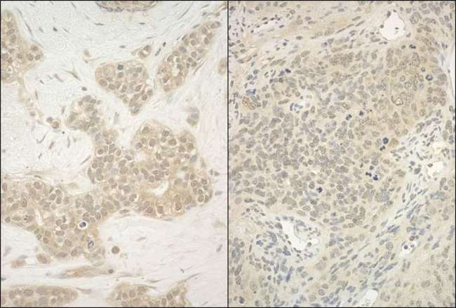 YY1 Antibody - Detection of Human and Mouse YY1 by Immunohistochemistry. Sample: FFPE section of human breast carcinoma (left) and mouse teratoma (right). Antibody: Affinity purified rabbit anti-YY1 used at a dilution of 1:200 (1 Detection: DAB.