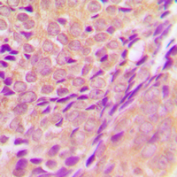 ZADH2 Antibody - Immunohistochemical analysis of ZADH2 staining in human breast cancer formalin fixed paraffin embedded tissue section. The section was pre-treated using heat mediated antigen retrieval with sodium citrate buffer (pH 6.0). The section was then incubated with the antibody at room temperature and detected using an HRP conjugated compact polymer system. DAB was used as the chromogen. The section was then counterstained with hematoxylin and mounted with DPX.