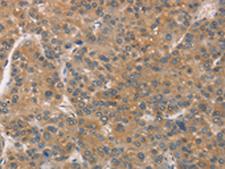 ZADH2 Antibody - Immunohistochemistry of paraffin-embedded Human liver cancer tissue  using ZADH2 Polyclonal Antibody at dilution of 1:51(×200)
