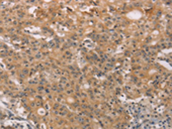 ZADH2 Antibody - Immunohistochemistry of paraffin-embedded Human gastric cancer tissue  using ZADH2 Polyclonal Antibody at dilution of 1:51(×200)