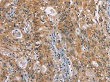 ZADH2 Antibody - Immunohistochemistry of paraffin-embedded Human gastric cancer tissue  using ZADH2 Polyclonal Antibody at dilution of 1:100(×200)