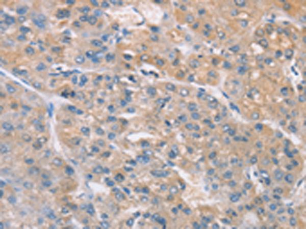 ZADH2 Antibody - Immunohistochemistry of paraffin-embedded Human liver cancer tissue  using ZADH2 Polyclonal Antibody at dilution of 1:100(×200)