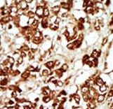 ZAK / MLTK Antibody - Formalin-fixed and paraffin-embedded human cancer tissue reacted with the primary antibody, which was peroxidase-conjugated to the secondary antibody, followed by AEC staining. This data demonstrates the use of this antibody for immunohistochemistry; clinical relevance has not been evaluated. BC = breast carcinoma; HC = hepatocarcinoma.