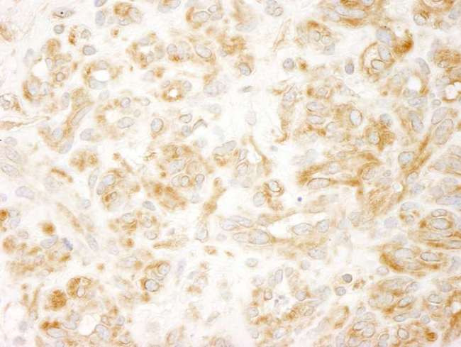 ZAK / MLTK Antibody - Detection of Human ZAK by Immunohistochemistry. Sample: FFPE section of human cervical carcinoma. Antibody: Affinity purified rabbit anti-ZAK used at a dilution of 1:250.