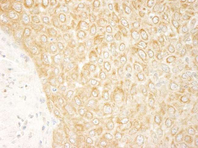 ZAK / MLTK Antibody - Detection of Human ZAK by Immunohistochemistry. Sample: FFPE section of human skin squamous cell carcinoma. Antibody: Affinity purified rabbit anti-ZAK used at a dilution of 1:250.