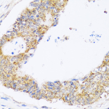 ZAK / MLTK Antibody - Immunohistochemistry of paraffin-embedded human colon carcinoma tissue.