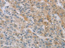 ZAK / MLTK Antibody - Immunohistochemistry of paraffin-embedded Human liver cancer tissue  using ZAK  Polyclonal Antibody at dilution of 1:100(×200)