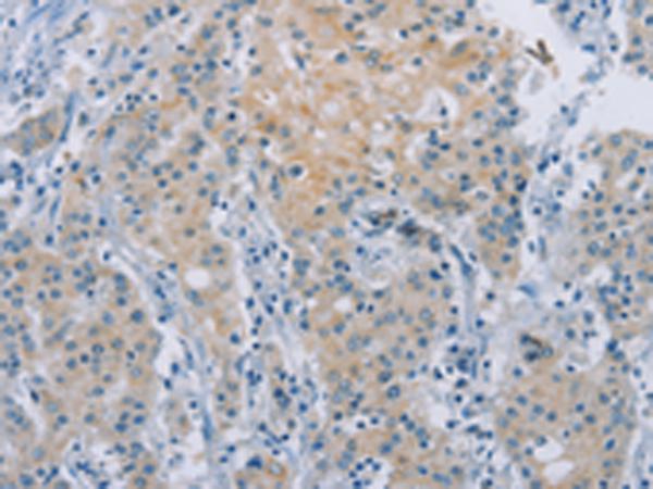 ZAK / MLTK Antibody - Immunohistochemistry of paraffin-embedded Human gastric cancer tissue  using ZAK  Polyclonal Antibody at dilution of 1:100(×200)