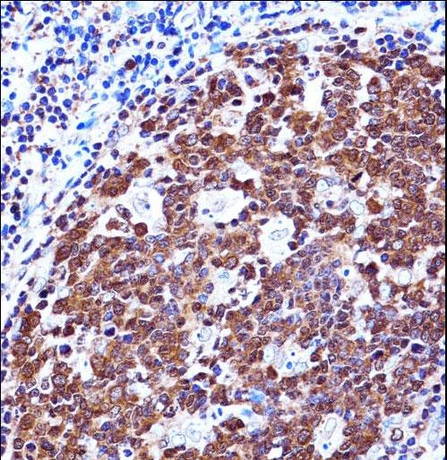 ZAP70 Antibody - ZAP70 Antibody immunohistochemistry of formalin-fixed and paraffin-embedded human tonsil tissue followed by peroxidase-conjugated secondary antibody and DAB staining.