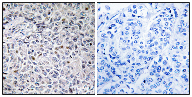 ZAP70 Antibody - Immunohistochemistry analysis of paraffin-embedded human breast carcinoma tissue, using ZAP-70 Antibody. The picture on the right is blocked with the synthesized peptide.