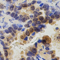 ZAP70 Antibody - Immunohistochemical analysis of ZAP70 staining in human lung cancer formalin fixed paraffin embedded tissue section. The section was pre-treated using heat mediated antigen retrieval with sodium citrate buffer (pH 6.0). The section was then incubated with the antibody at room temperature and detected using an HRP polymer system. DAB was used as the chromogen. The section was then counterstained with hematoxylin and mounted with DPX.