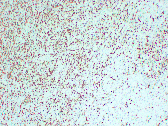 ZAP70 Antibody - Hodgkin'S Lymphoma 1