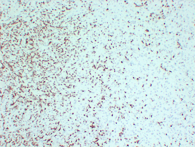 ZAP70 Antibody - Hodgkin'S Lymphoma 2
