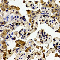 ZAP70 Antibody - Immunohistochemical analysis of ZAP70 staining in human lung cancer formalin fixed paraffin embedded tissue section. The section was pre-treated using heat mediated antigen retrieval with sodium citrate buffer (pH 6.0). The section was then incubated with the antibody at room temperature and detected using an HRP polymer system. DAB was used as the chromogen. The section was then counterstained with hematoxylin and mounted with DPX.