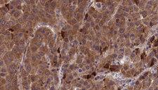 ZAP70 Antibody - 1:100 staining human liver carcinoma tissues by IHC-P. The sample was formaldehyde fixed and a heat mediated antigen retrieval step in citrate buffer was performed. The sample was then blocked and incubated with the antibody for 1.5 hours at 22°C. An HRP conjugated goat anti-rabbit antibody was used as the secondary.