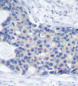 ZAP70 Antibody - Immunohistochemical analysis of paraffin-embedded human breast carcinoma tissue.
