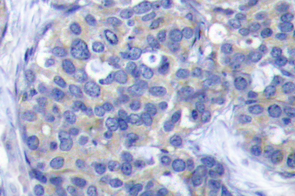ZAP70 Antibody - IHC of ZAP-70 (S313) pAb in paraffin-embedded human breast carcinoma tissue.