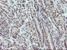ZBED1 / TRAMP Antibody - IHC of paraffin-embedded Carcinoma of Human thyroid tissue using anti-ZBED1 mouse monoclonal antibody.