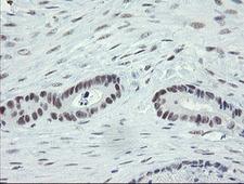 ZBED1 / TRAMP Antibody - IHC of paraffin-embedded Adenocarcinoma of Human colon tissue using anti-ZBED1 mouse monoclonal antibody.