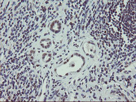 ZBED1 / TRAMP Antibody - IHC of paraffin-embedded Carcinoma of Human kidney tissue using anti-ZBED1 mouse monoclonal antibody.