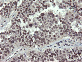 ZBED1 / TRAMP Antibody - IHC of paraffin-embedded Carcinoma of Human pancreas tissue using anti-ZBED1 mouse monoclonal antibody.