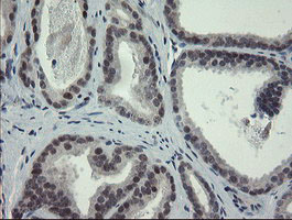 ZBED1 / TRAMP Antibody - IHC of paraffin-embedded Carcinoma of Human prostate tissue using anti-ZBED1 mouse monoclonal antibody.