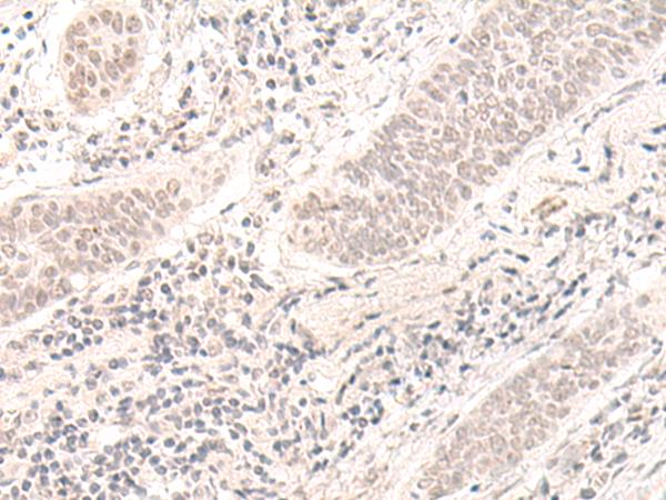 ZBED1 / TRAMP Antibody - Immunohistochemistry of paraffin-embedded Human esophagus cancer tissue  using ZBED1 Polyclonal Antibody at dilution of 1:40(×200)