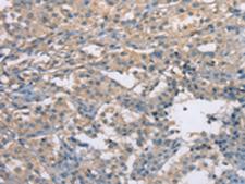 ZBP1 Antibody - Immunohistochemistry of paraffin-embedded Human thyroid cancer tissue  using ZBP1 Polyclonal Antibody at dilution of 1:50(×200)