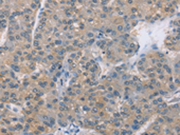 ZBP1 Antibody - Immunohistochemistry of paraffin-embedded Human liver cancer tissue  using ZBP1 Polyclonal Antibody at dilution of 1:50(×200)
