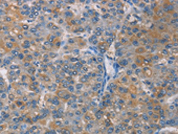 ZBTB1 Antibody - Immunohistochemistry of paraffin-embedded Human liver cancer tissue  using ZBTB1  Polyclonal Antibody at dilution of 1:50(×200)