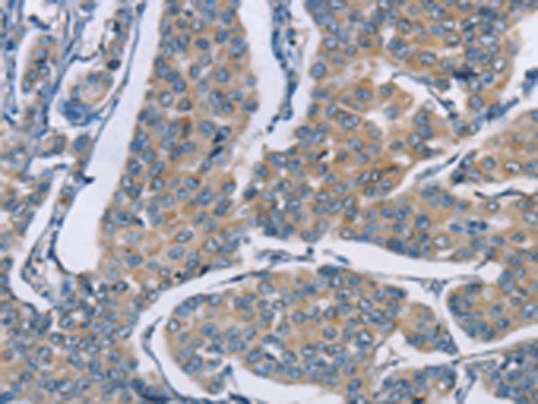 ZBTB1 Antibody - Immunohistochemistry of paraffin-embedded Human breast cancer tissue  using ZBTB1  Polyclonal Antibody at dilution of 1:50(×200)