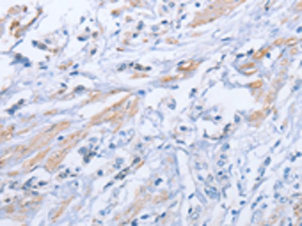 ZBTB1 Antibody - Immunohistochemistry of paraffin-embedded Human prost at e cancer tissue  using ZBTB1  Polyclonal Antibody at dilution of 1:50(×200)